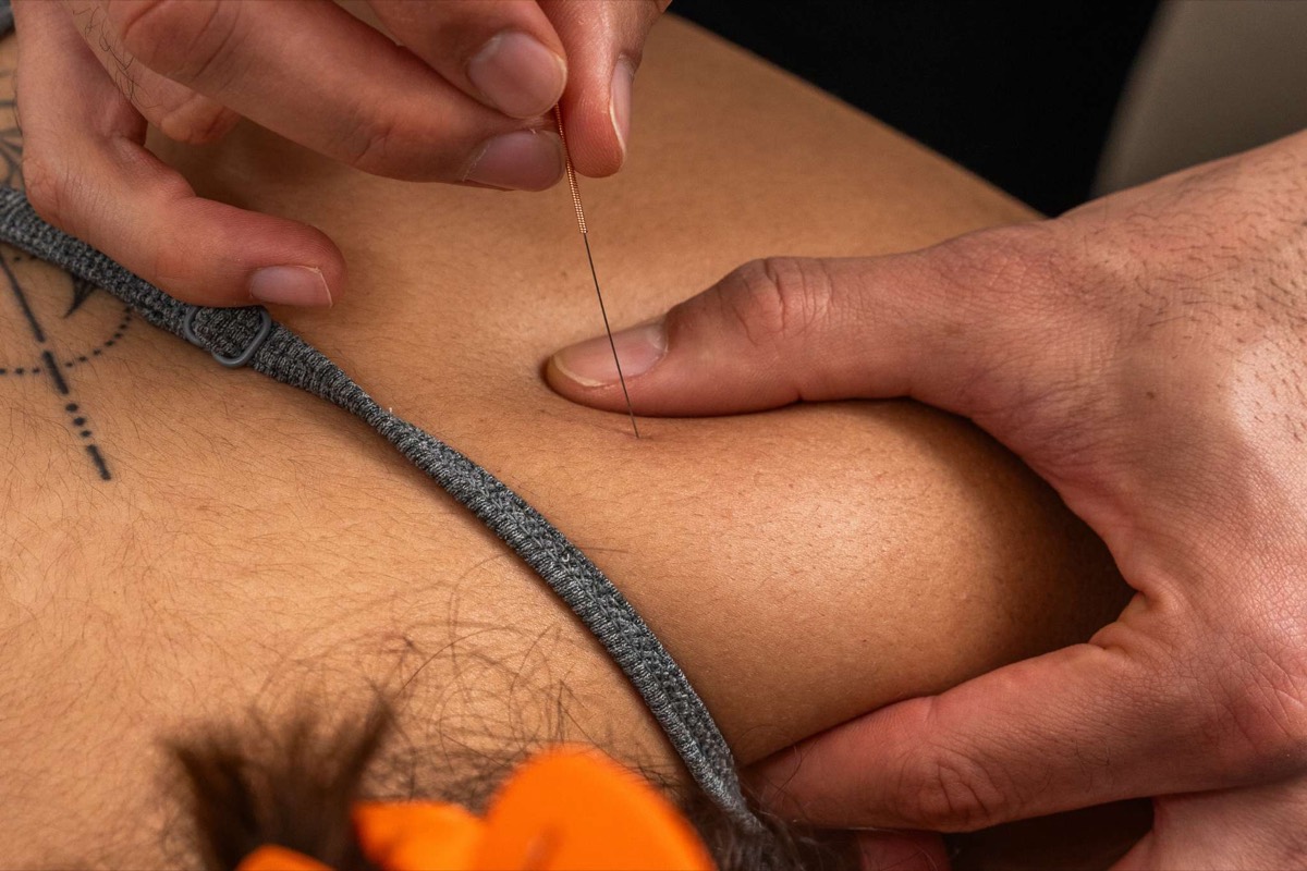 Dry needling treatment at Spine and Health Co